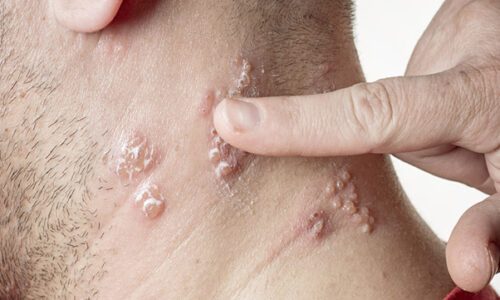 Ciclopirox Lotion Manufacturer and Supplier