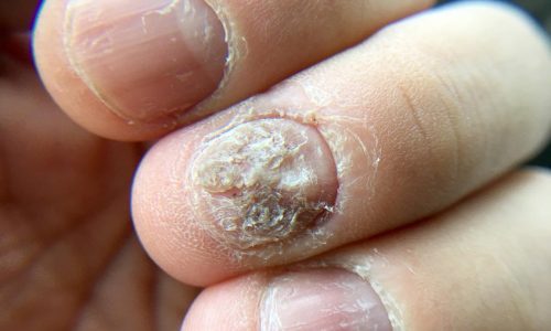 nail-fungus